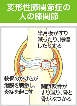 変形性膝関節症の人の膝関節